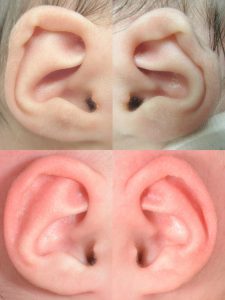 Before and after photographs of an infant ear with a conchal crus, mild prominence and a helical rim difference