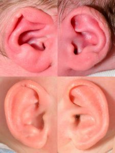 Before and after photographs of an infant with lidding of the left ear and a prominent right ear