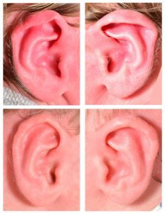 Before and after photographs of an infant ear with lidding