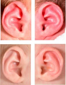 Before and after photographs of an infant with Stahl's ear on the right and a prominent left ear