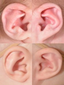 Before and after photographs of an infant ear with Stahl's ear shape