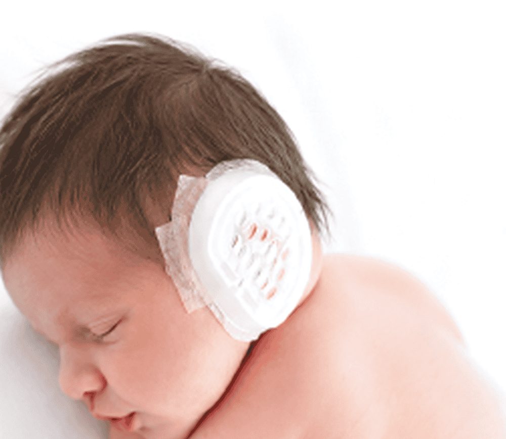 A sleeping newborn wearing a white ear molding device over one ear
