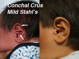 Infant ear with arrows marking a cartilage ridge across the ear bowl, labeled conchal crus with mild Stahl's, beside the ear after molding