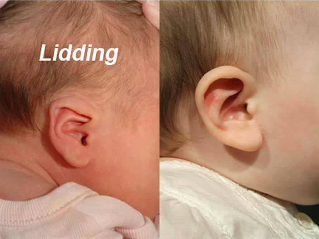 Paired photographs of an infant ear whose upper rim folds down like a lid, before and after molding