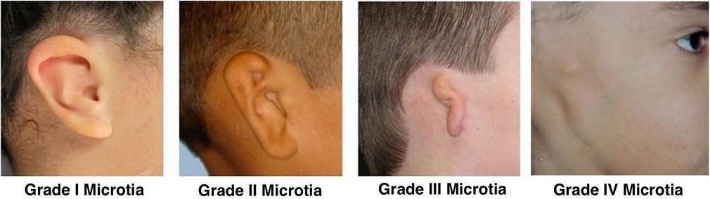 Four photographs showing outer ears labeled microtia grade I through grade IV, from mild underdevelopment to absence of most of the outer ear