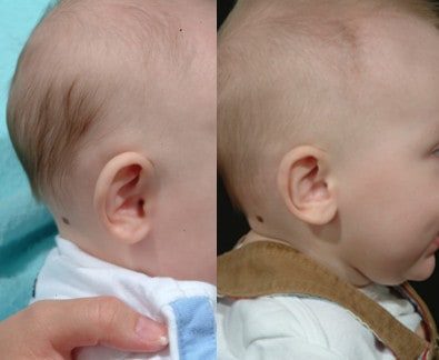 Paired photographs of an infant ear that stands away from the head, before and after molding
