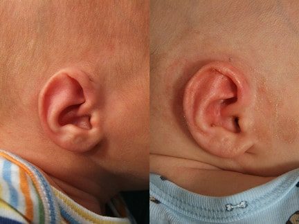 Paired photographs of an infant ear with an extra upper cartilage fold, before and after molding
