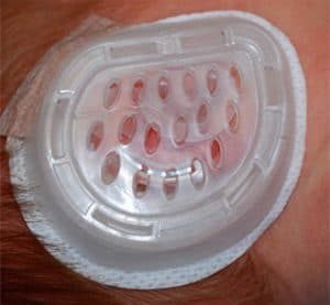 Completed EarWell application with the clear front shell closed over an infant ear