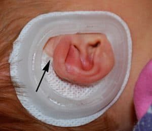 The EarWell posterior shell positioned behind an infant ear