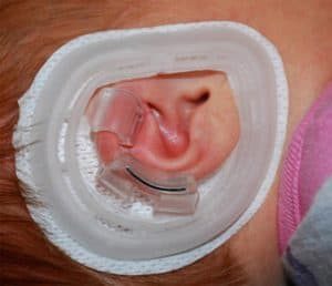 EarWell retractors shaping the rim of an infant ear inside the cradle
