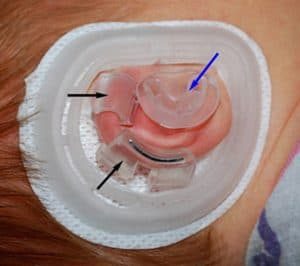 EarWell device retractors and conchal bowl former positioned on an infant ear