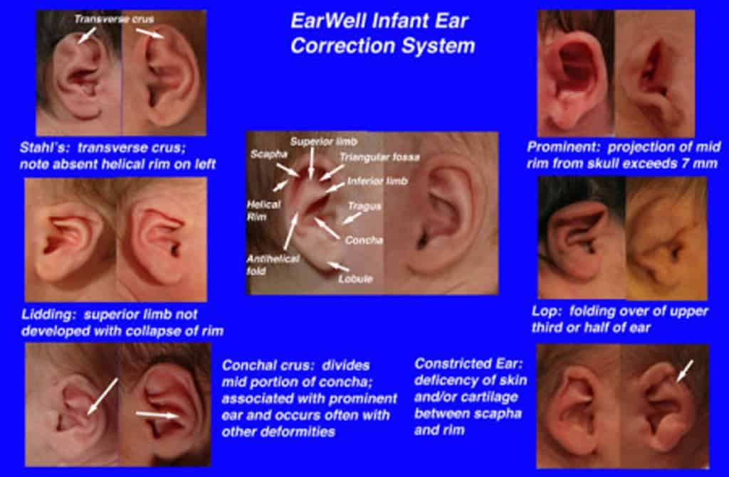 Chart of labeled newborn ear photographs comparing Stahl's ear, lidding, prominent ear, lop ear, conchal crus and constricted ear with a typical ear