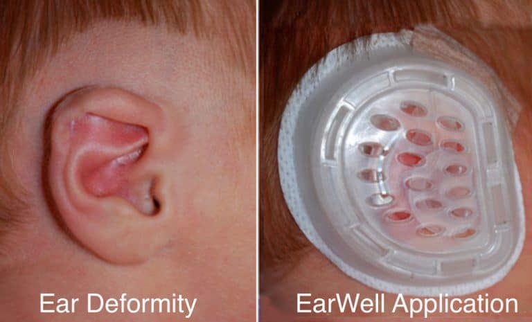Side-by-side photographs of an infant ear with a shape difference and the same ear with the clear EarWell molding device applied